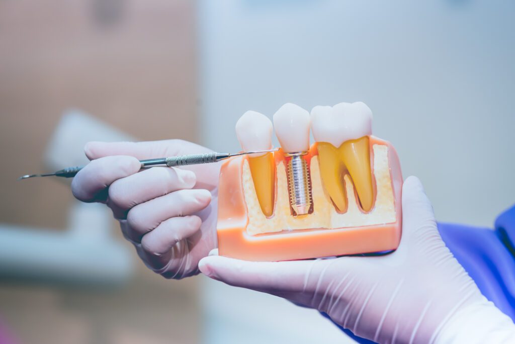 dental implants in Peabody