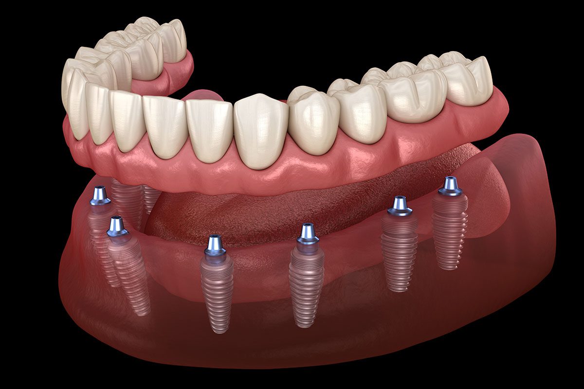 Dental Arts on Essex - dental implants in Peabody - Why Dental Implants in Peabody Are the Best Solution for Missing Teeth dental implants in Peabody